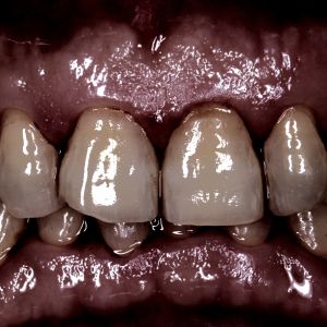 upper front teeth with visible discoloration, plaque buildup and gum inflammation